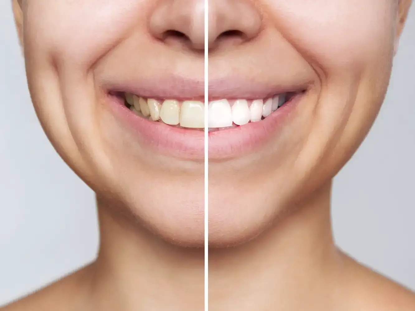 Consulting, fabrication and application of aesthetic dental veneers - VERCELLI Dental Office 42 Milan, Italy