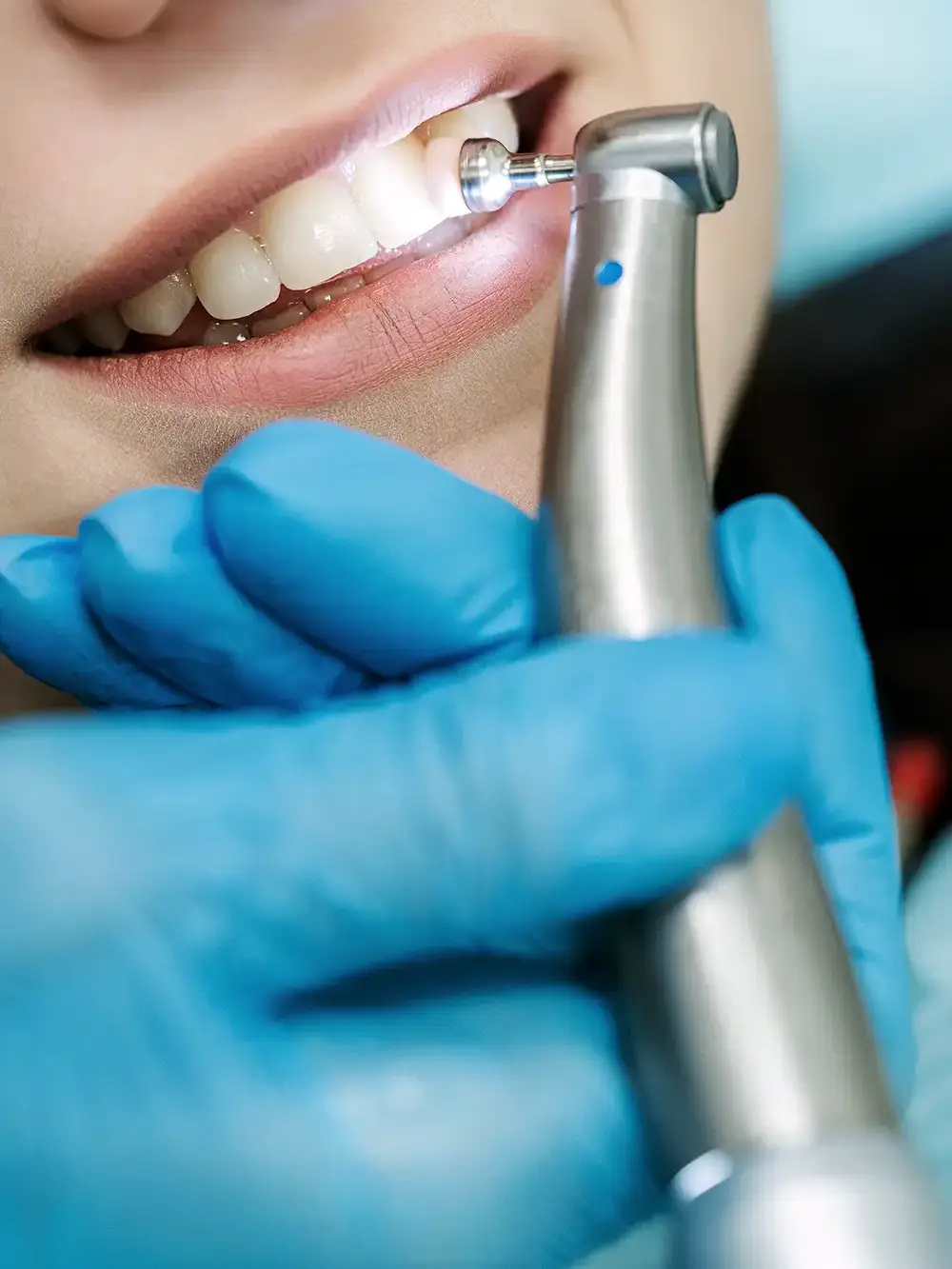 Dental Hygiene - VERCELLI 42 Dental Practice, Milan