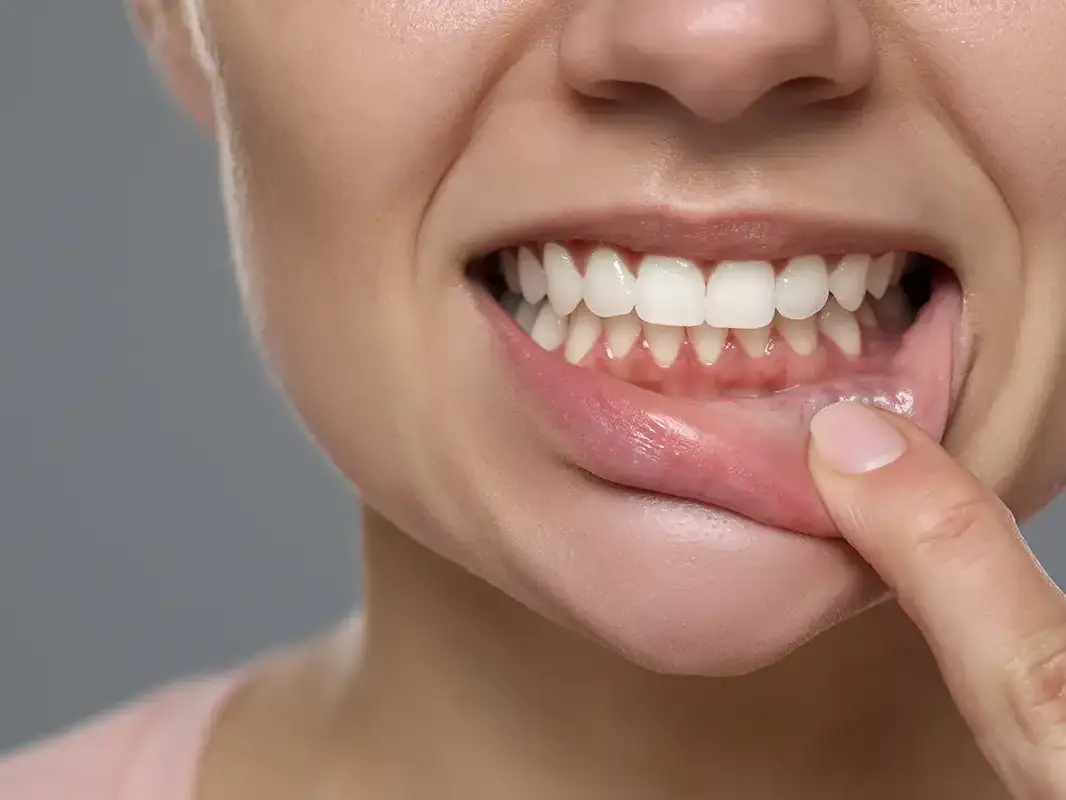 Advanced Gum Grafting - VERCELLI 42 Dental Practice, Milan