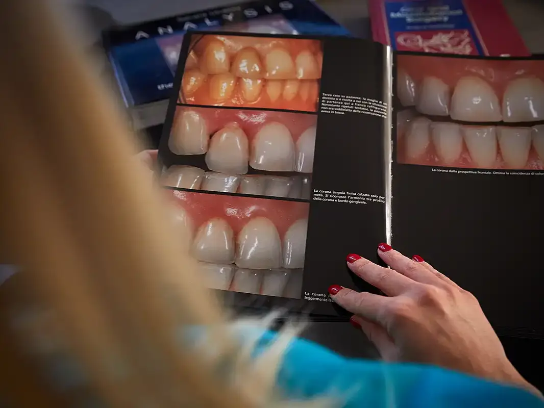 Advanced Gum Grafting - VERCELLI 42 Dental Practice, Milan
