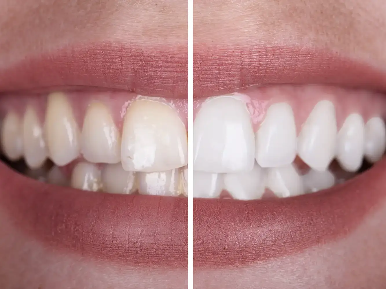 Teeth whitening treatment in Milan - Studio VERCELLI 42